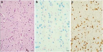 Iron, Ferritin, Hereditary Ferritinopathy, and Neurodegeneration